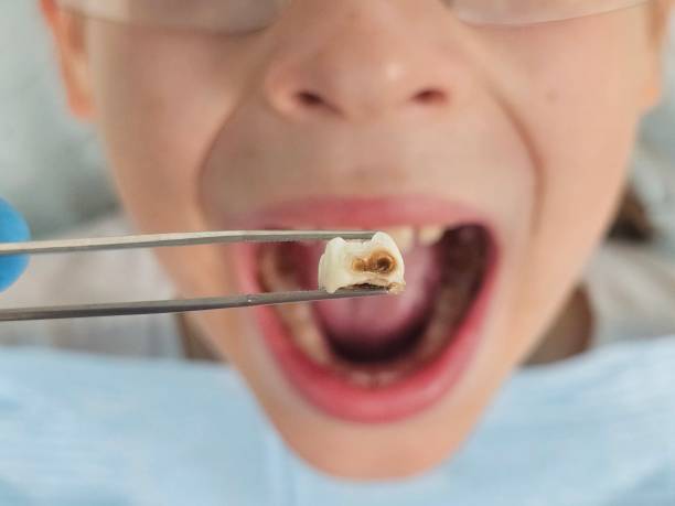Best Emergency Tooth Extraction in Bloomer, WI